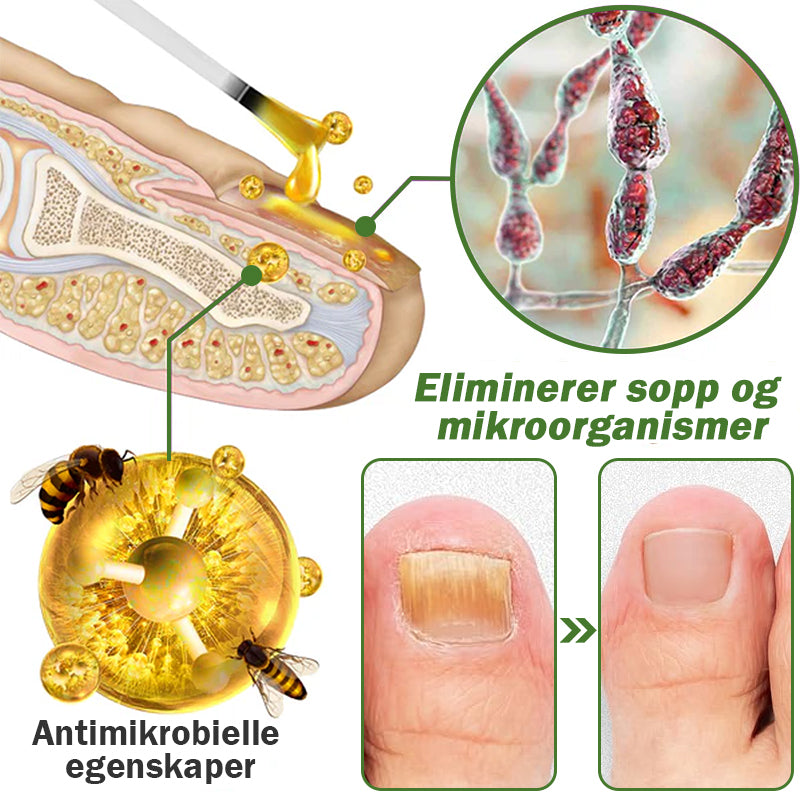 HONXI™ Neglbeskyttelse Biegift Behandlingsserum(For alle typer neglesykdommer✅For sunnere neglevekst)